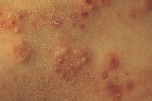 Dermatitis Herpetiformis Coeliac Uk